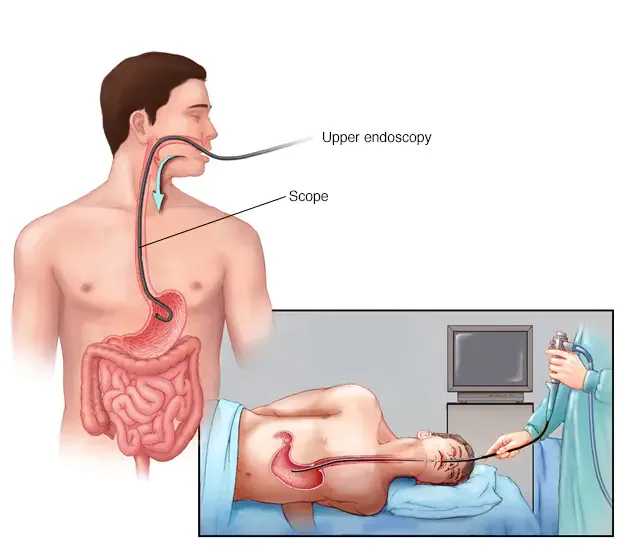 gerd surgery