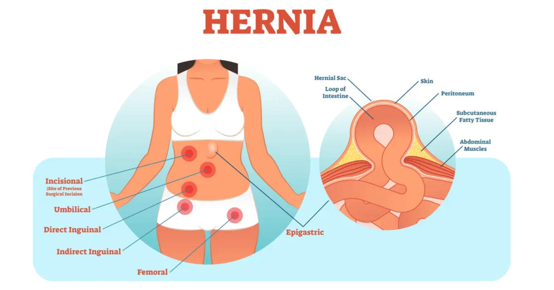 Hernia Surgeon in Delhi