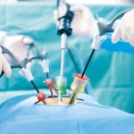 Laparoscopic surgeries
