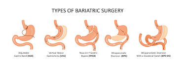 obesity-sergery