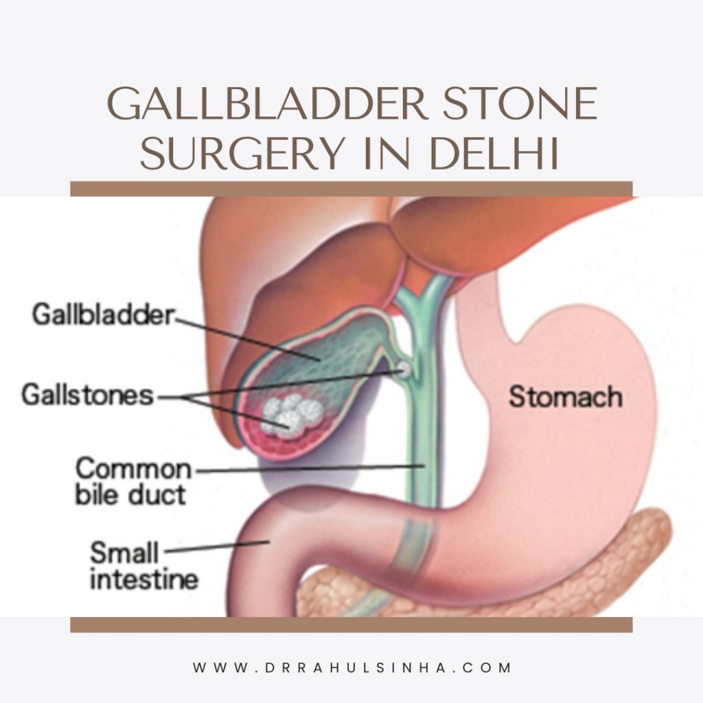 Gallbladder stone surgery in Delhi